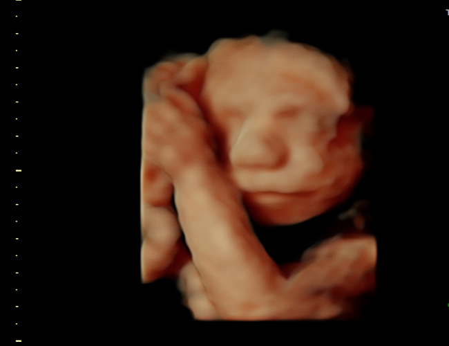 3D ultrasound image at 25 weeks